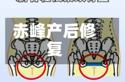 赤峰产后修复
