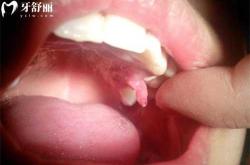 烂牙根会影响男孩备孕吗