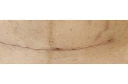 剖腹产一月后伤口还疼正常吗