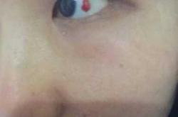 婴儿白眼球有红血块是怎么回事