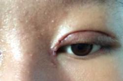 产后缝针出现息肉该咋办