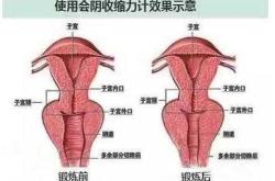 产后阴道红肿怎么办