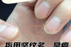 婴儿指甲出现竖纹是怎么回事