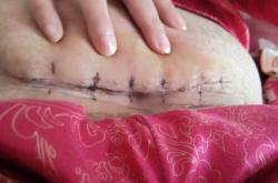 剖腹产后18天又流血了怎么办