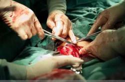 剖腹产用钛合金线有啥好处