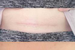 剖腹产刀口增生有水咋办