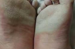 婴儿脚不平怎么办