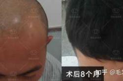 做植发后多久备孕合适