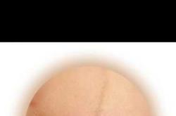 剖腹产刀口特别大是怎么回事