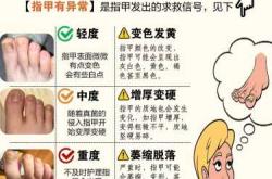 备孕灰指甲怎么治愈