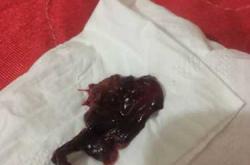 产后排出胎膜图片是怎样的