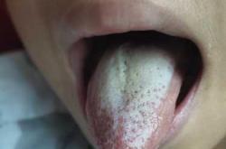 婴儿舌尖红是怎么回事