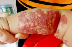 婴儿后脑勺红色胎记咋回事