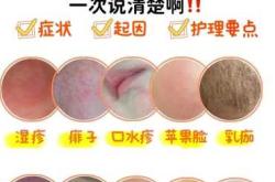 哪种尿不湿不会尿布疹