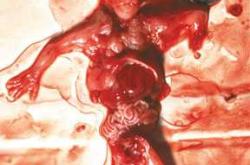 引产后20天还出血怎么回事