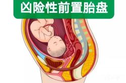 胎盘前置男性易备孕吗