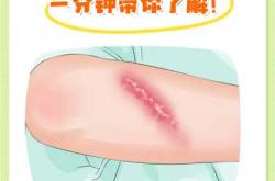 剖腹产出现液化有啥图片