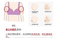产后有副乳该怎么解决