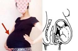 剖腹产屁股麻木如何办