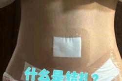 剖腹产两次结扎后能复通再生吗