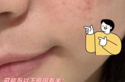 顺产后脸上出现出血点咋回事