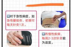 孕反扎针灸有效吗