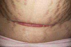 剖腹产刀口麻了正常吗