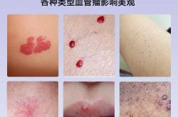 婴儿嘴唇血管瘤怎么办
