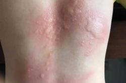 婴儿荨麻疹有啥症状表现