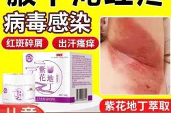 婴儿真菌感染怎么办