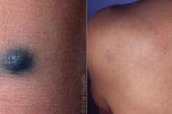 婴儿蒙古斑图片什么样