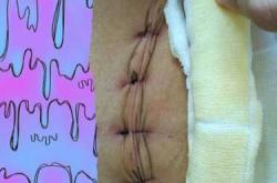 剖腹产42天仍出血正常吗