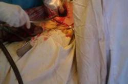 剖腹产的孩子胆小吗