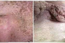 产后外阴口长疙瘩咋回事