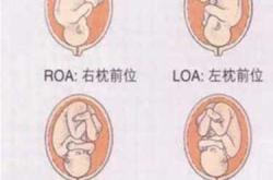 胎位rop能顺产吗