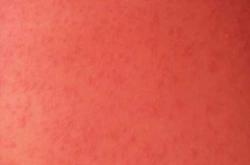 过敏期间能怀孕吗