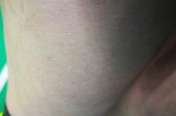 婴儿不出汗正常吗