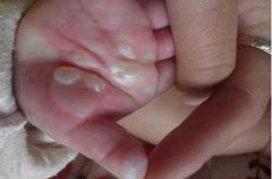 婴儿皮肤破皮如何快速处理