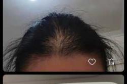 产后掉头发正常吗