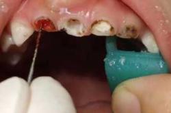 备孕为何要检查牙龈炎