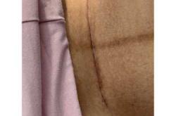 剖腹产9天伤口仍疼正常吗