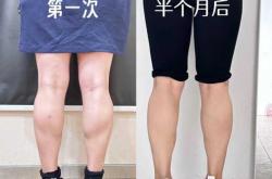 怀孕能瘦腿吗是真的吗