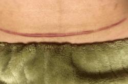 剖腹产疤痕厚度如何测量