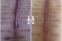 剖腹产增生前期啥情况