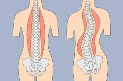 产后腰椎侧弯是怎么回事