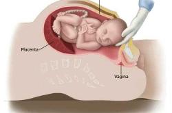 剖腹产后阴道会松吗