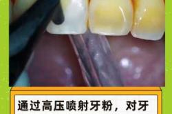 备孕女性可超声洗牙吗