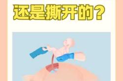 剖腹产比顺产更紧致吗