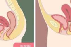 产后为何会得震感病