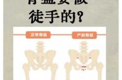 产后如何评估盆骨状态